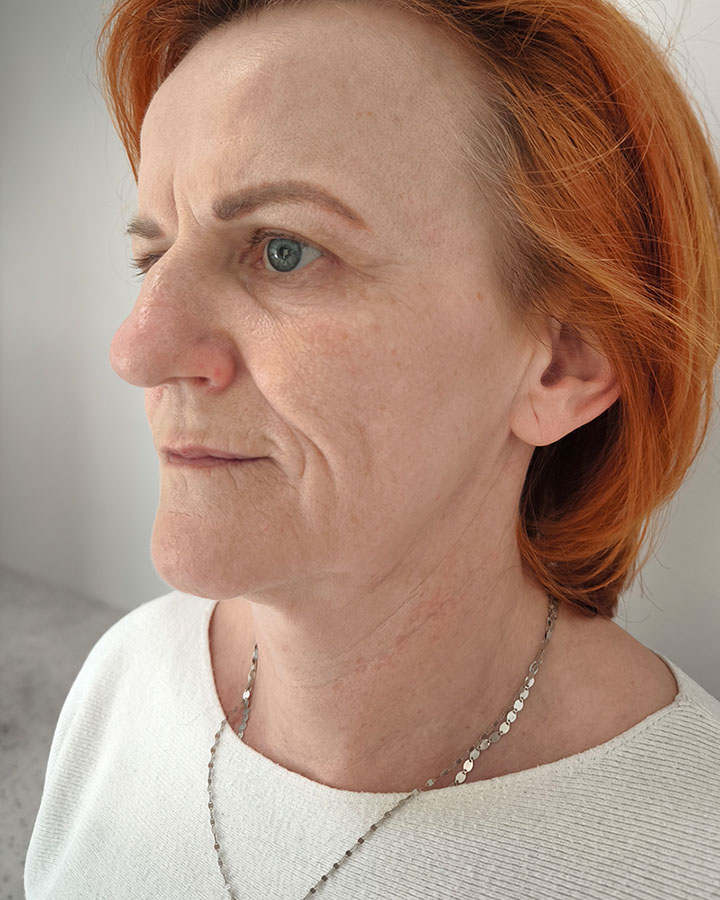 Ochabnutá pokožka tváre a unavený výraz pred aplikáciou kyseliny hyalurónovej