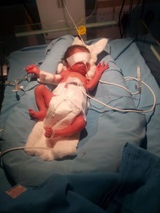 Preterm Birth