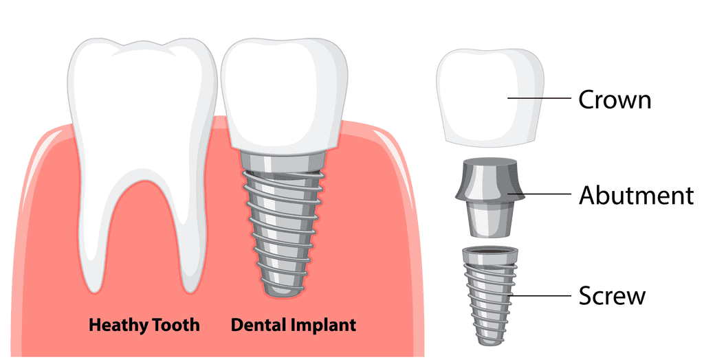 What are Dental Implants in Hong Kong