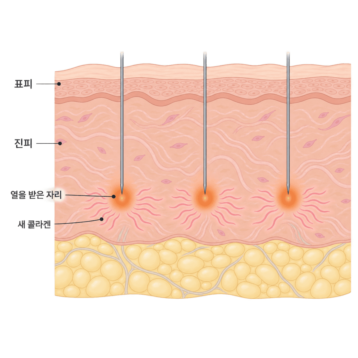 바늘 끝 열 자리가 새 콜라겐으로 바뀌어요