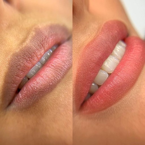 Crop view of lips, before and after the procedure