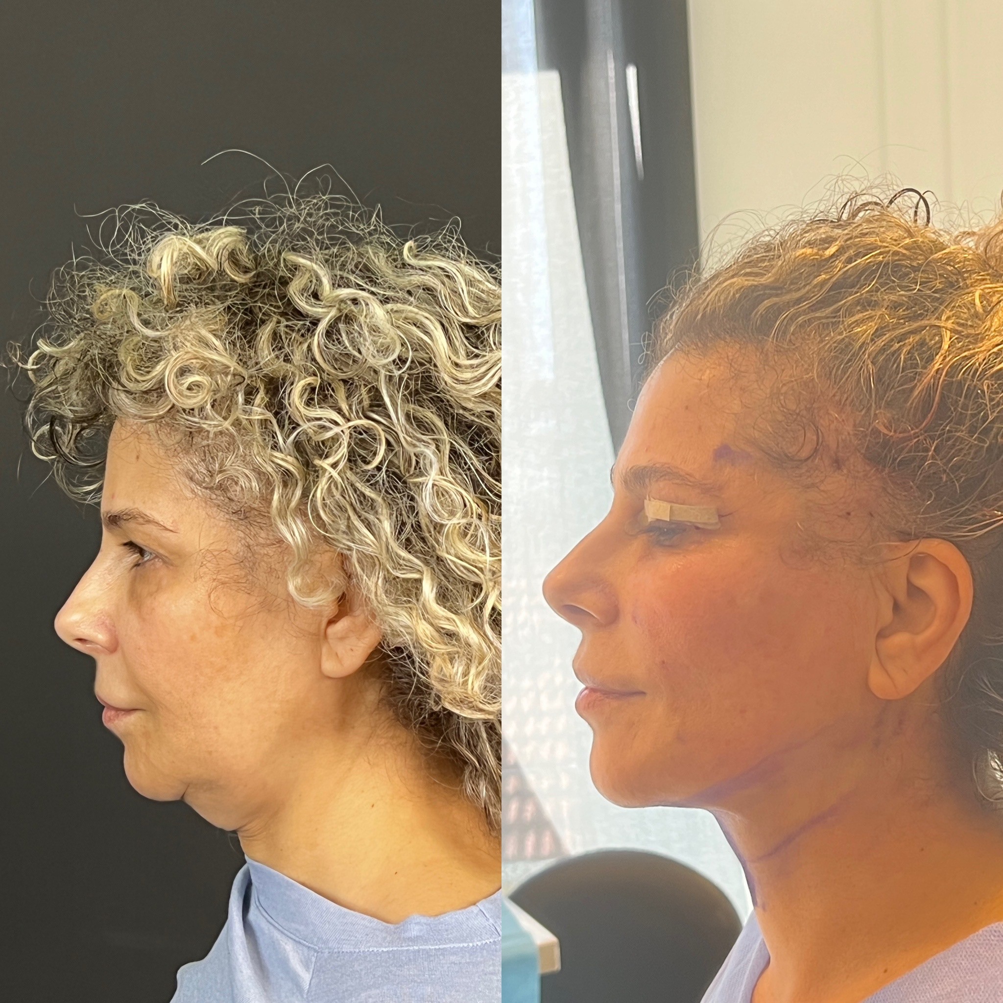 turkey neck liposuction thread lift immediate result right side view