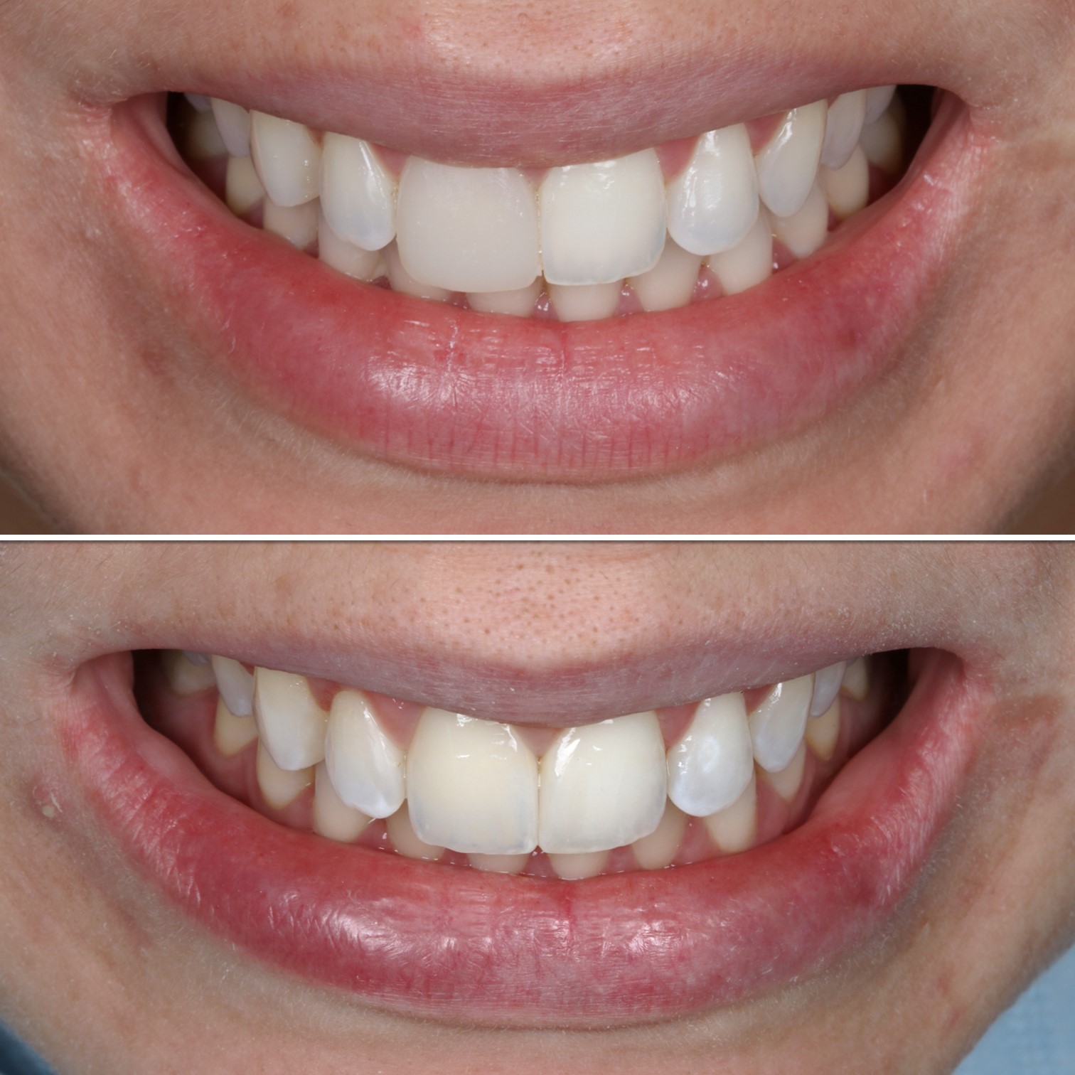 Fotos antes e depois de um sorriso.