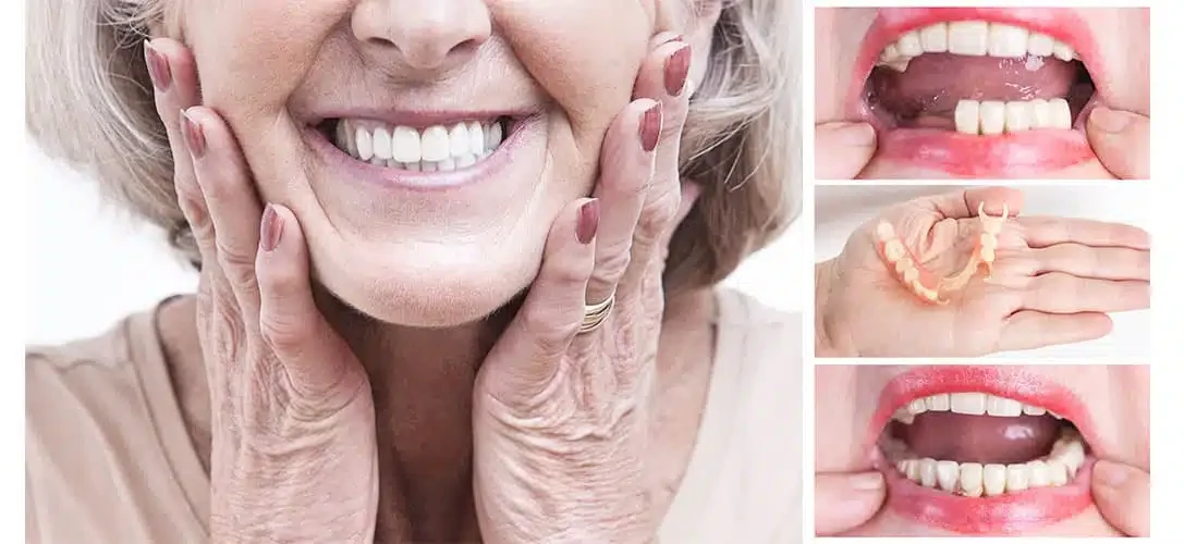 Removable denture treatment at COSDENT Smile Design
