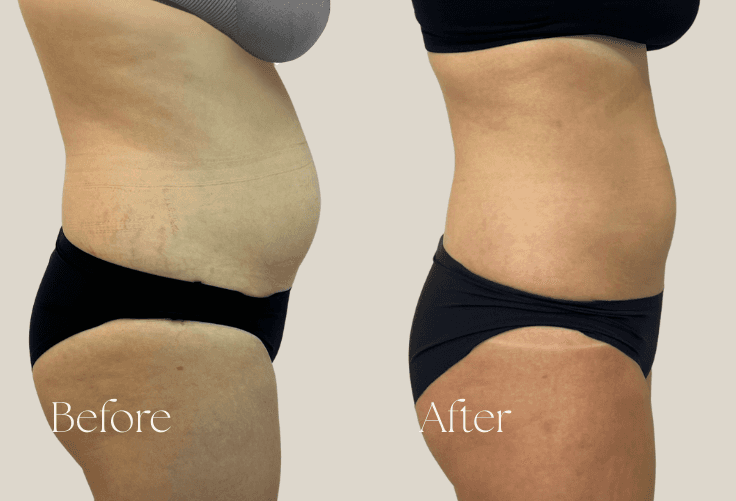 Cellulite treatment