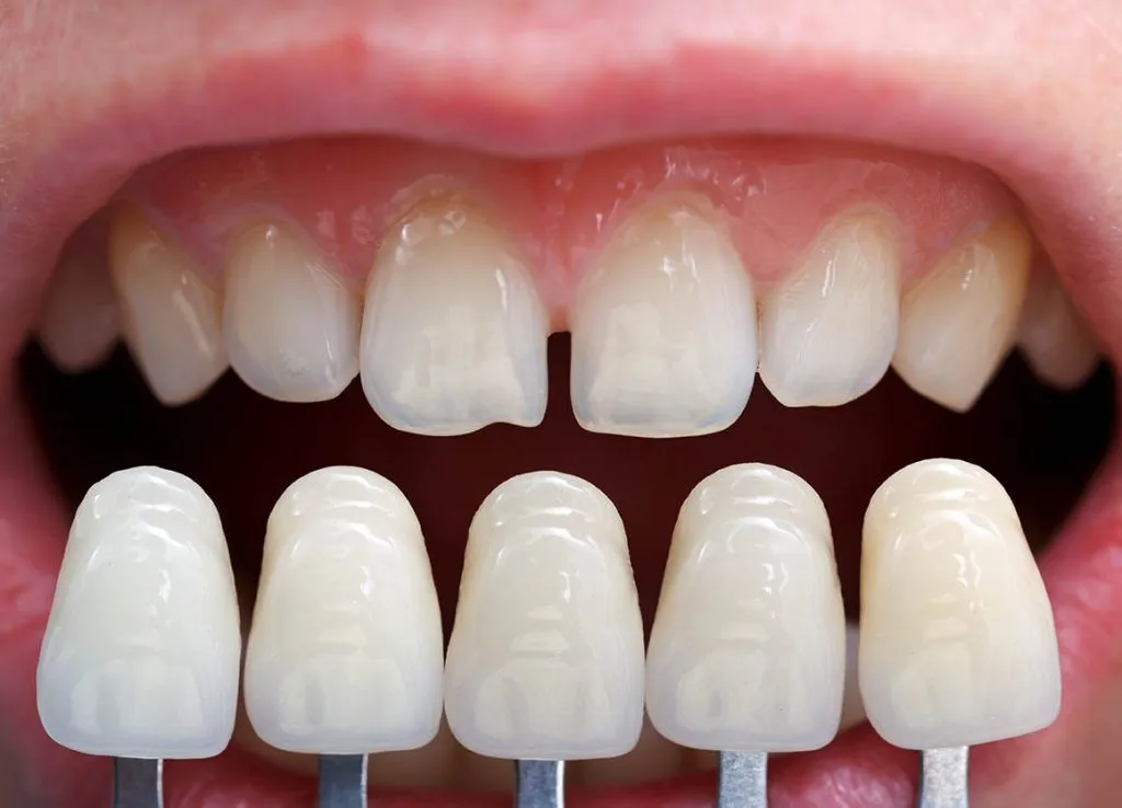 Veneers procedure