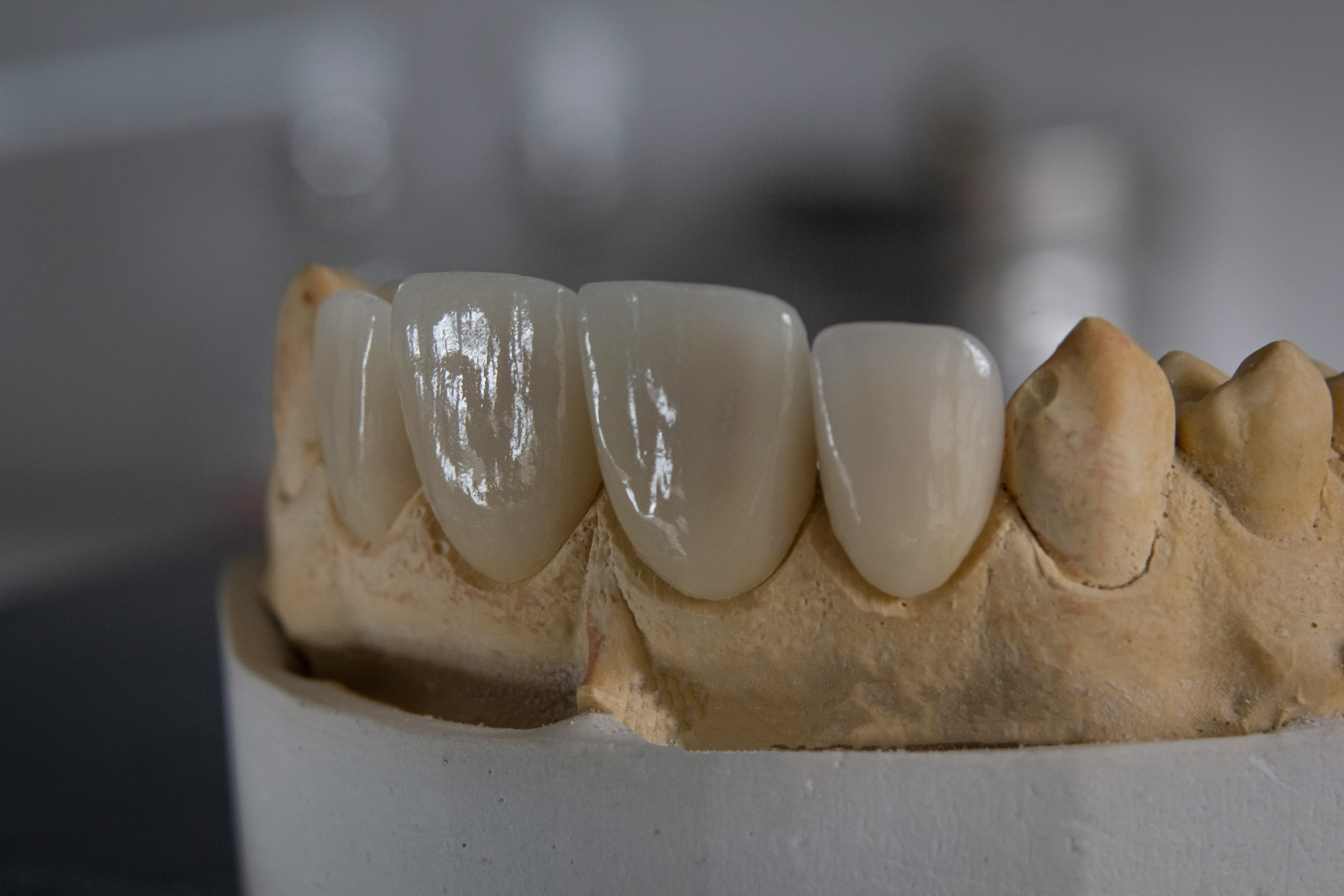 dental bridges