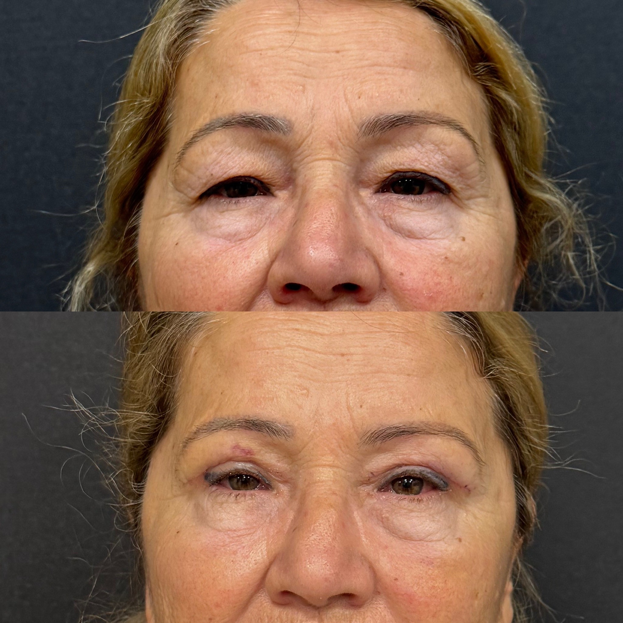 upper blepharoplasty surgery result before after photo 7 days post-surgery front view