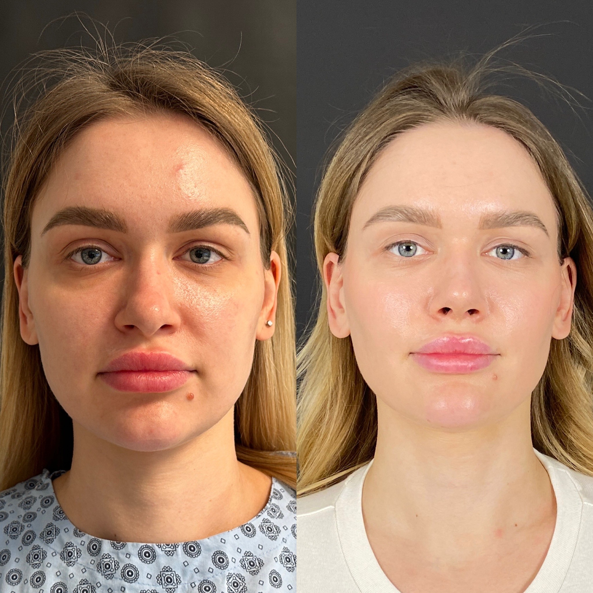 5 days cast removal of rhinoplasty before after front view