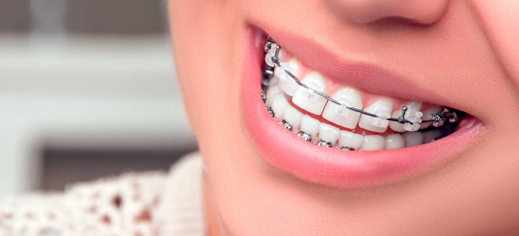 Sorriso com implante dentário ilustrado na gengiva, mostrando dentes brancos e saudáveis após reabilitação oral