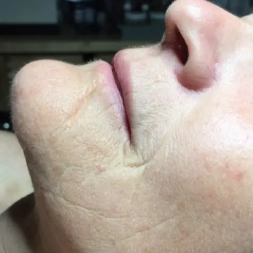 After LED light therapy at The Vancouver Aesthetician — wrinkles visibly softened and skin tone more even and refined