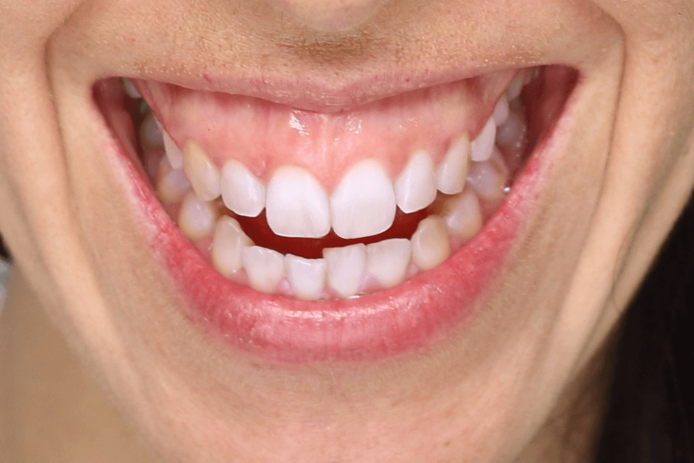 A close view of a gummy smile showing excess gum display and short-looking teeth, highlighting uneven gum levels before treatment.