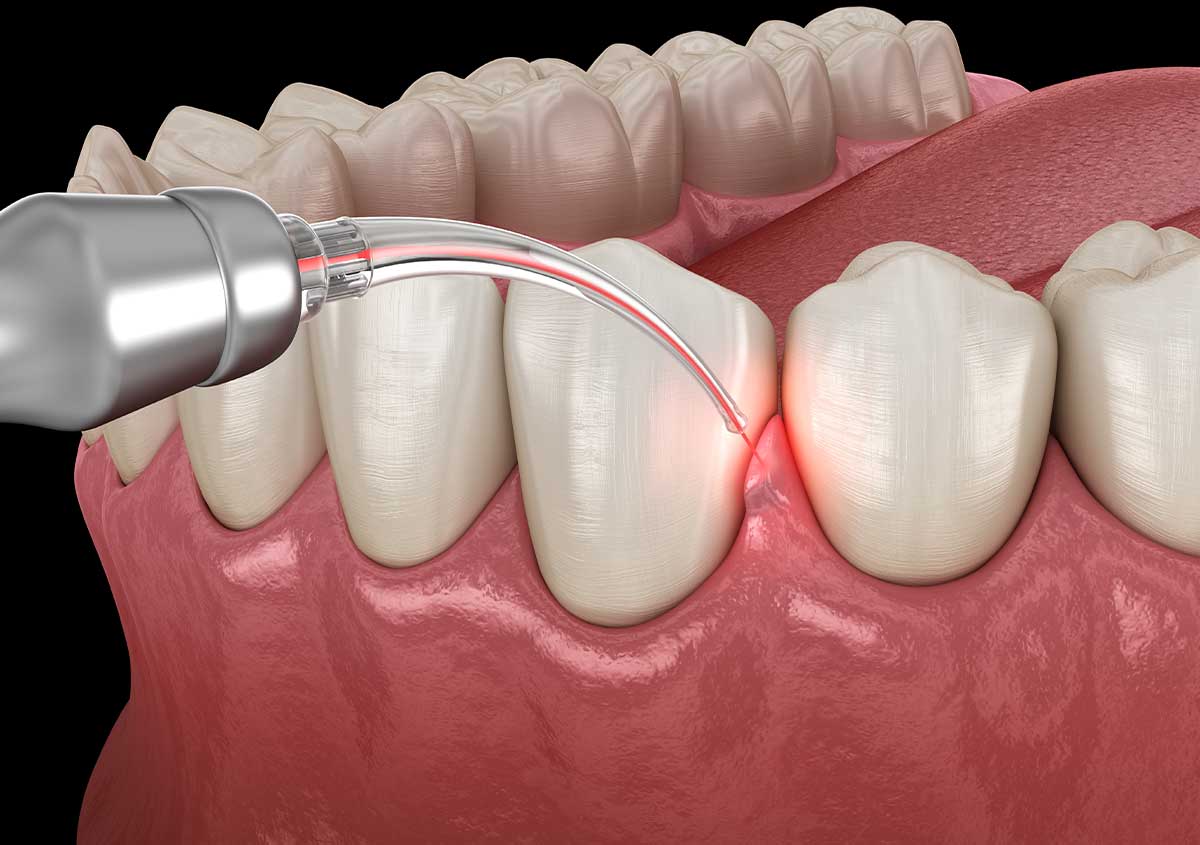 Antibiotic Treatment for Gum Disease in Newark & Milltown NJ