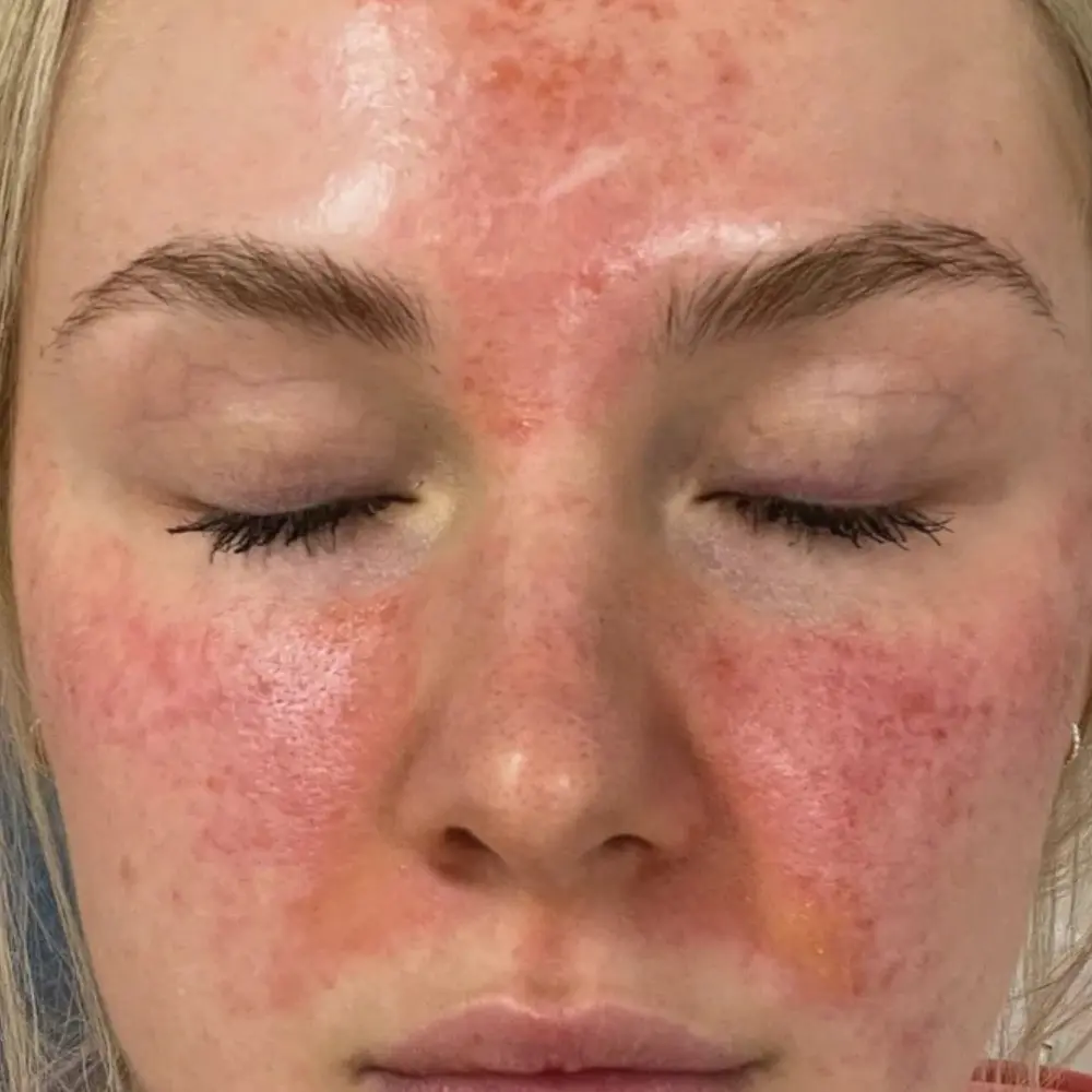 vancouver-aesthetician-hydrators-reactive-skin-damaged-barrier-hydrating-facial-before