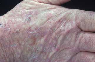 Figure 2: Solar keratosis