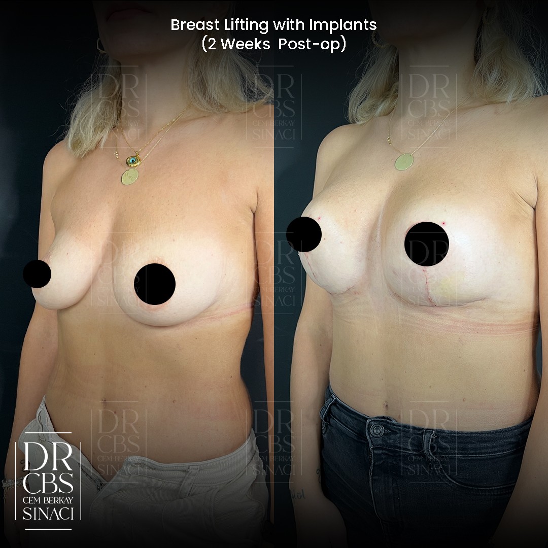 breast lift with implant before after 2 weeks post-operative oblique view 