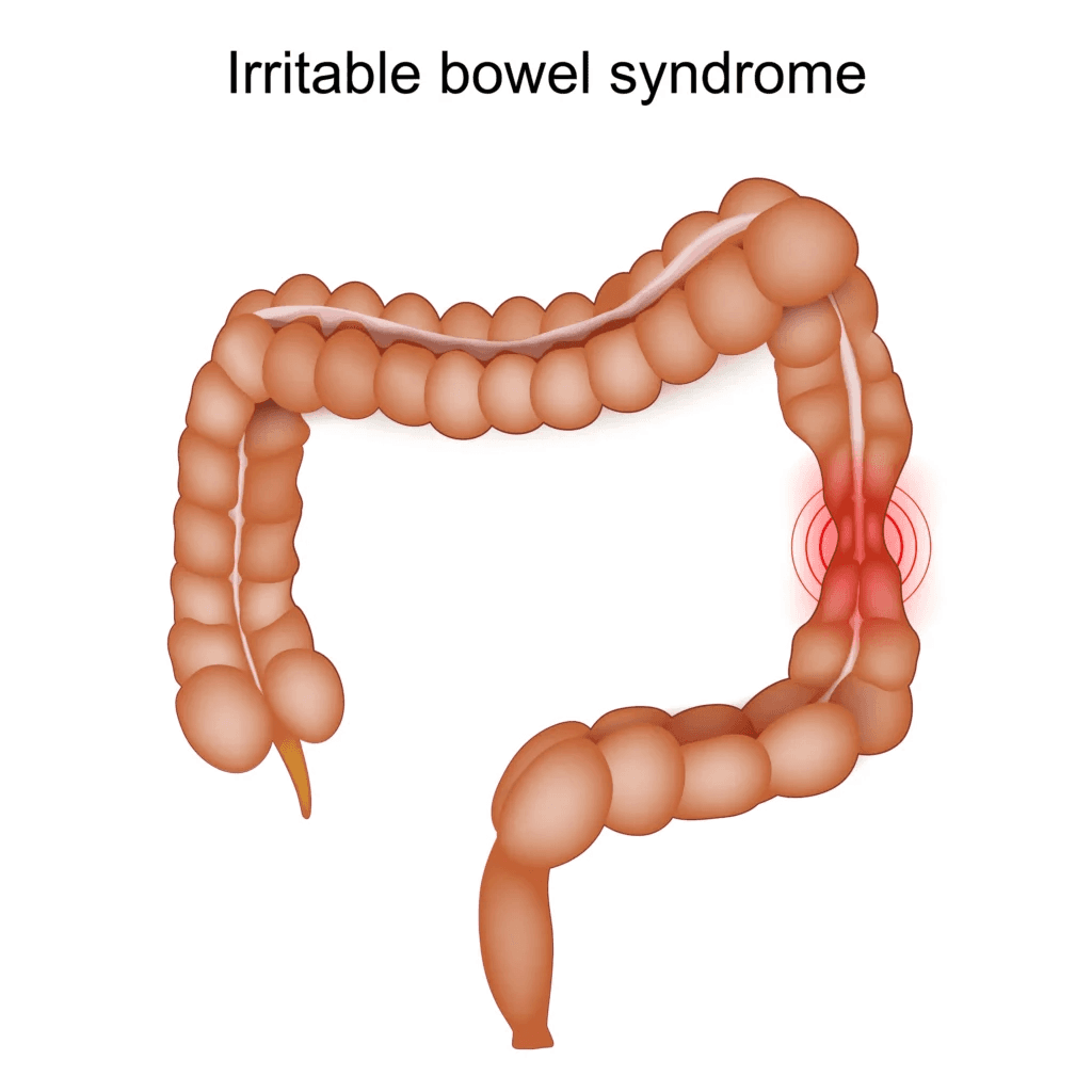 IBS and Insomnia Practical Steps Patients Can Start Today