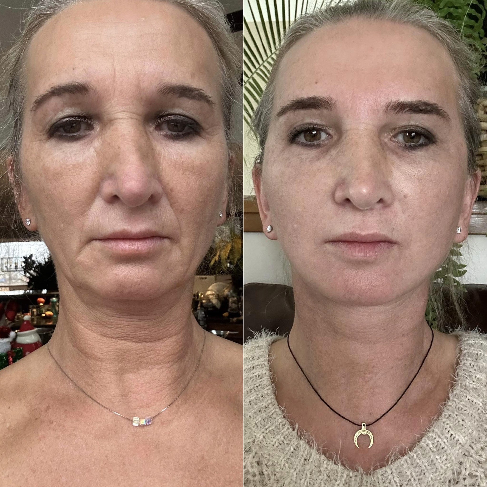 2 months post-op deep plane face neck lift and browlift before after front view