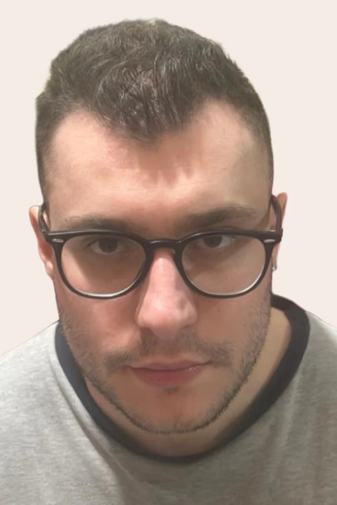 Dichtes Haarwachstum und verjüngtes Erscheinungsbild nach der Eigenhaartransplantation