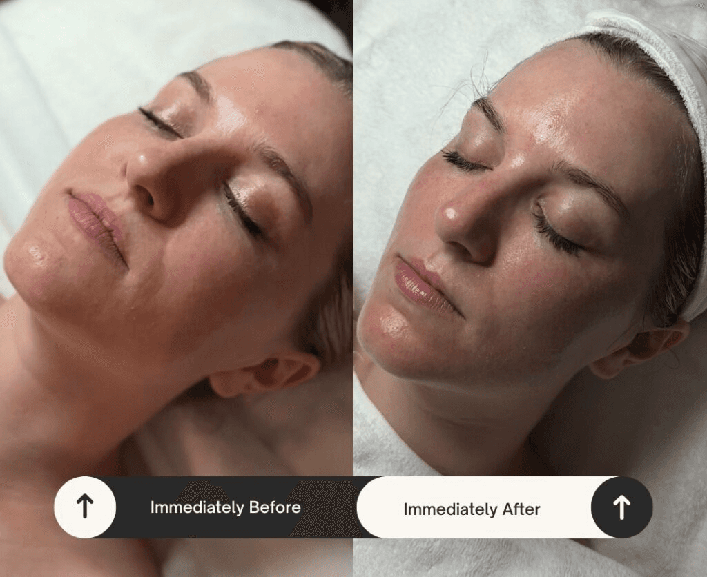 Benefits of Salmon PDRN for Skin: What Results Can You Expect?