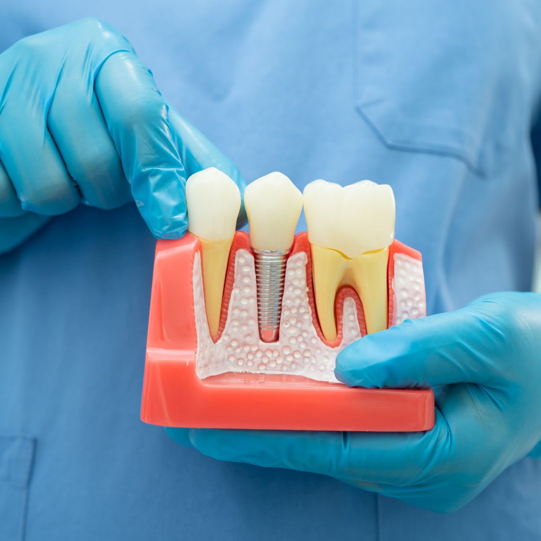 Tooth replacement model showing dental implant procedure at Dentistree Kolkata.