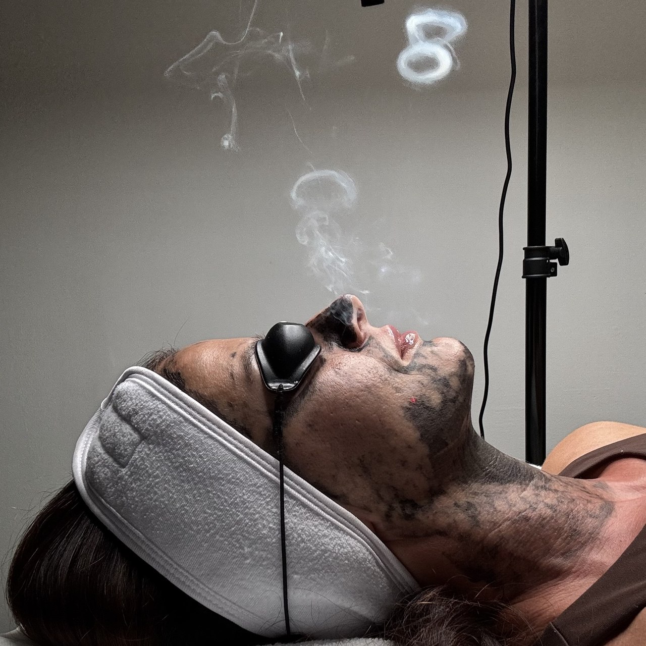 Carbon laser peel treatment at Subbot Beauty Studio in West Roxbury Boston