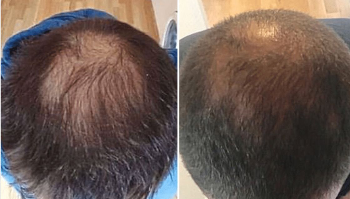 Hair Restoration