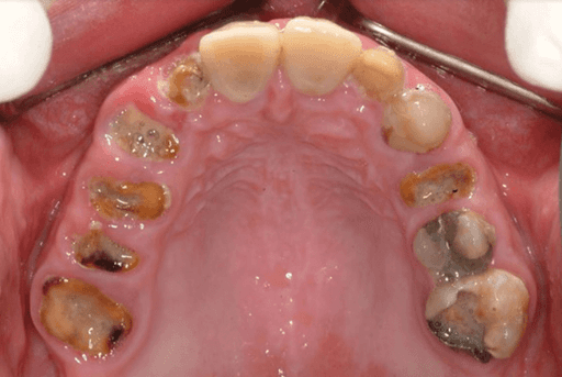 decayed tooth