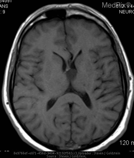 MRI image of a brain