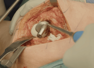 Hip hemiarthroplasty - posterior approach