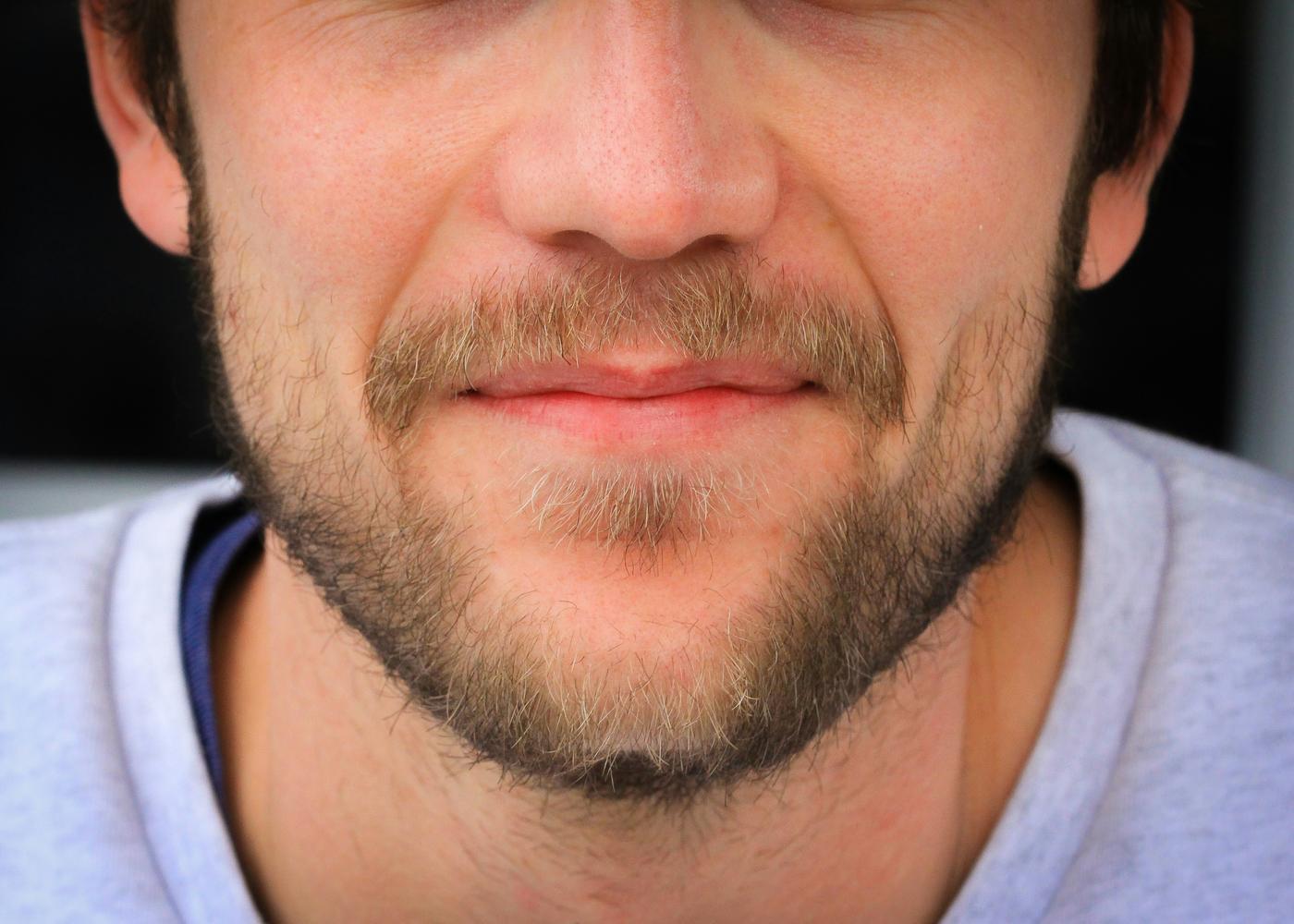 Minoxidil Growth Study - Closeup of a man's beard