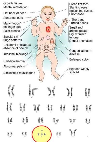 Karyotype Of A Female With Trisomy 21
