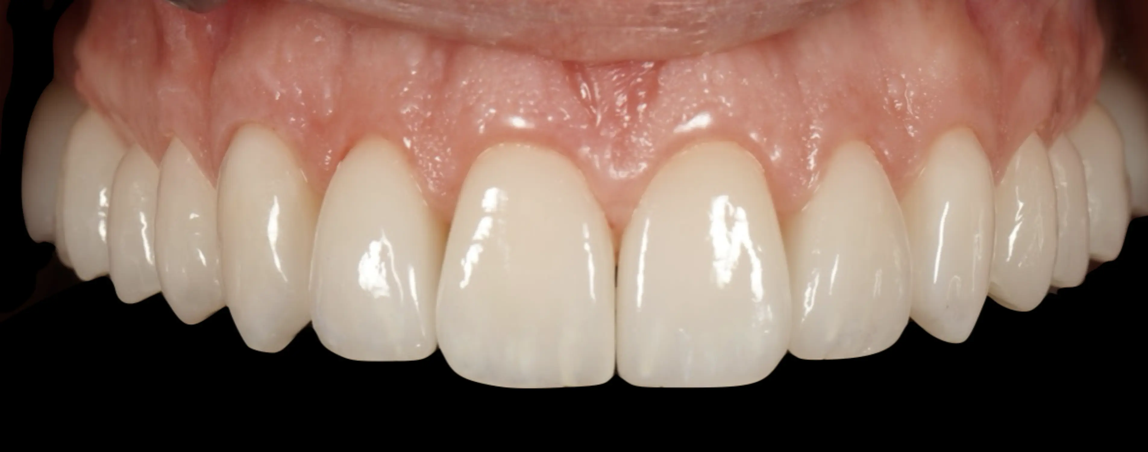Veneers and crowns (case 1)