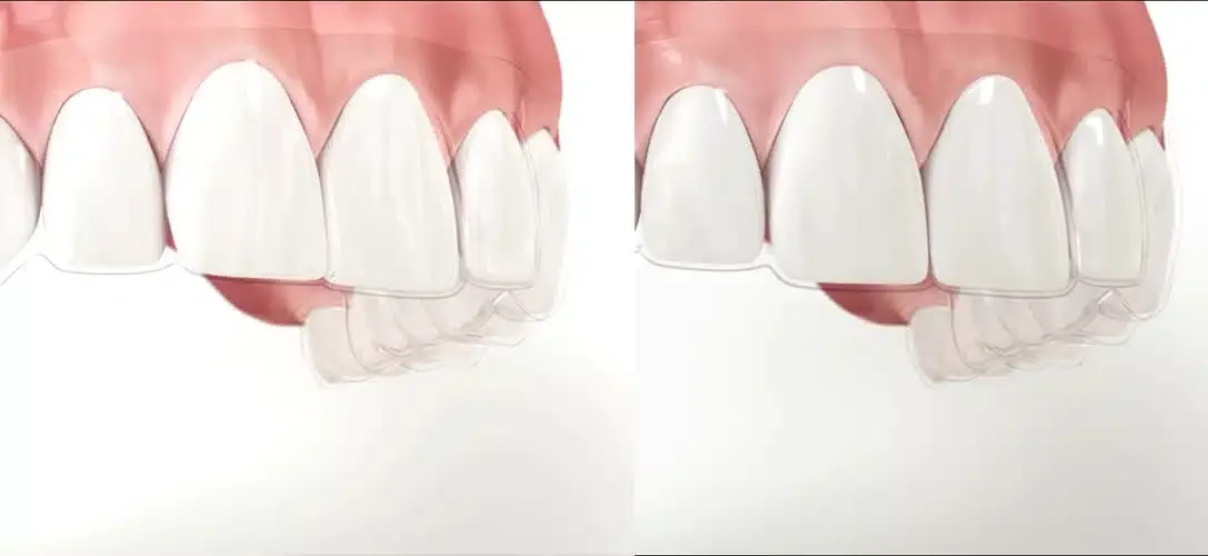 3D digital simulation of progressive tooth movement with Invisalign clear aligners at COSDENT